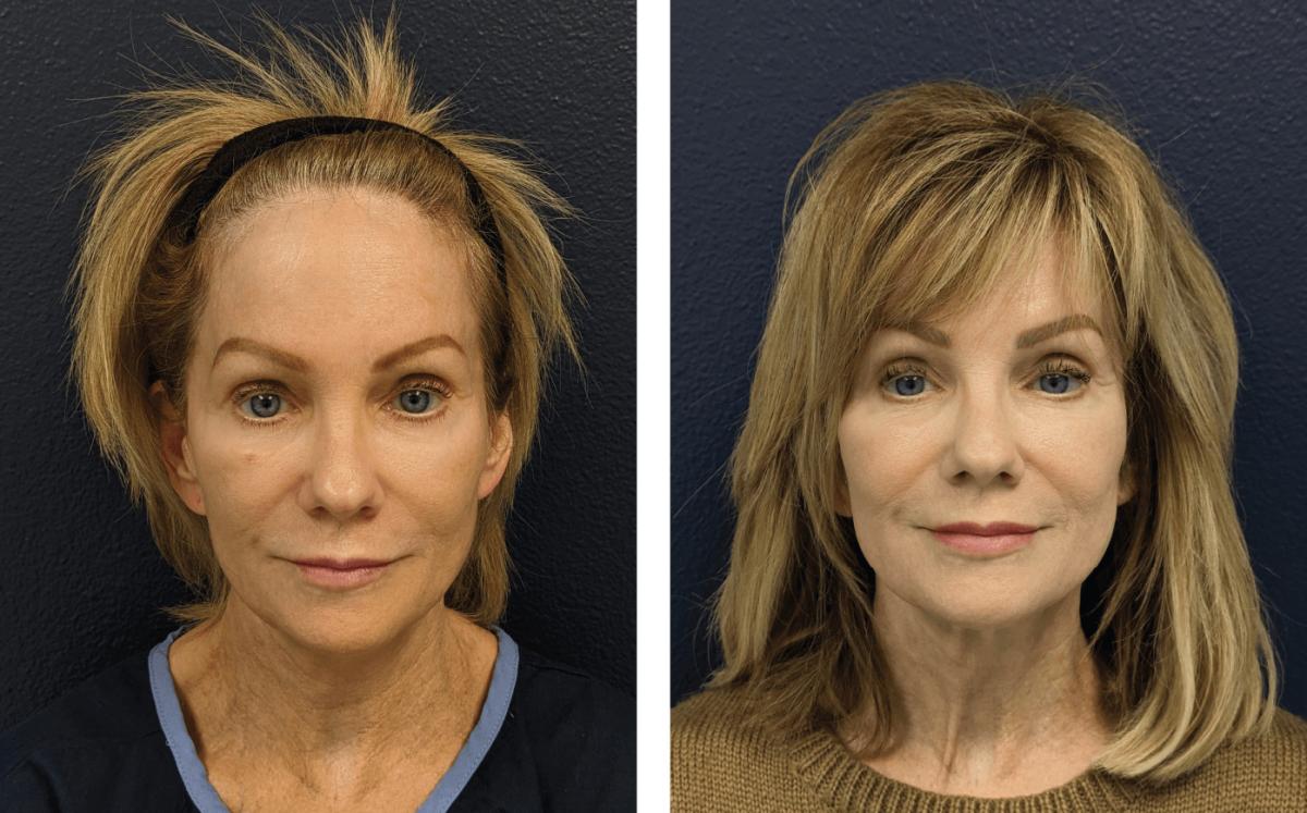 Before and after from a CO2 laser resurfacing treatment