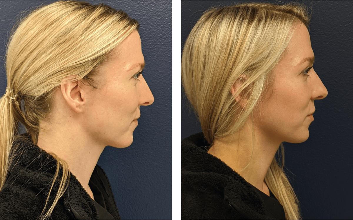 Before and after of a CO2 laser resurfacing treatment at the Elston Clinic