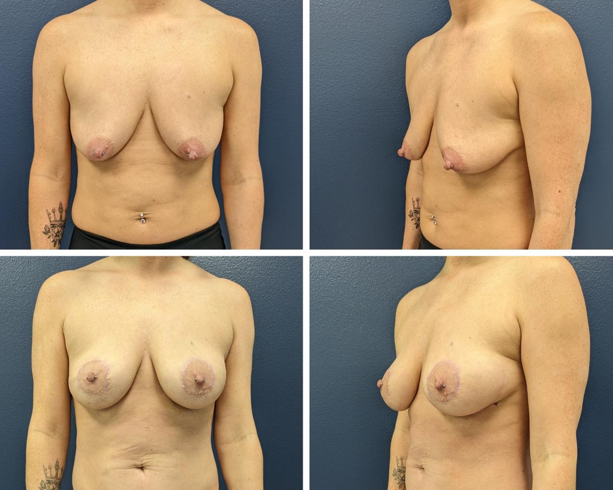 Breast lift with fat grafting before and after
