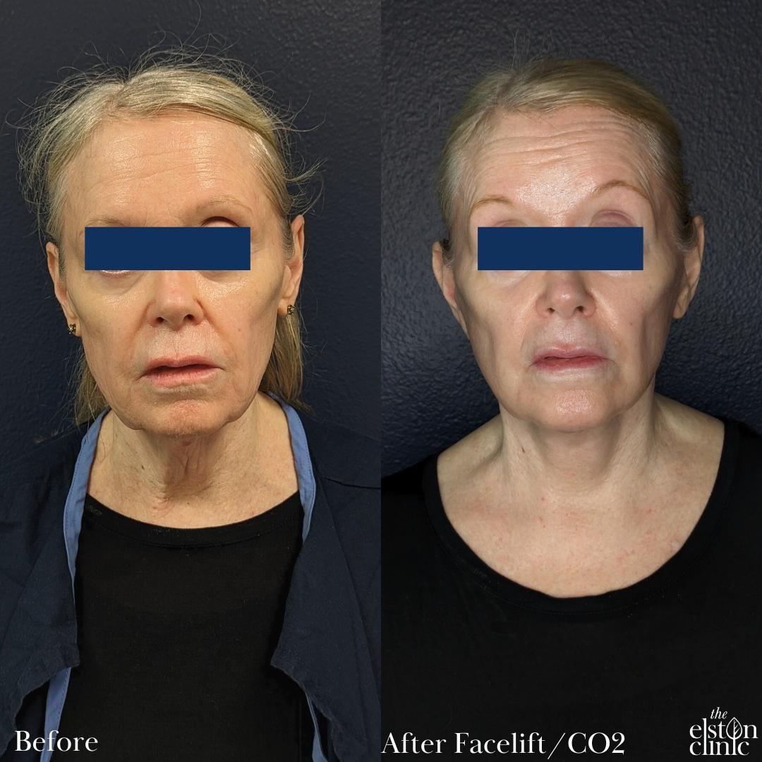 Before and after images of a patient who underwent awake face and necklift with CO2 laser resurfacing at the Elston Clinic