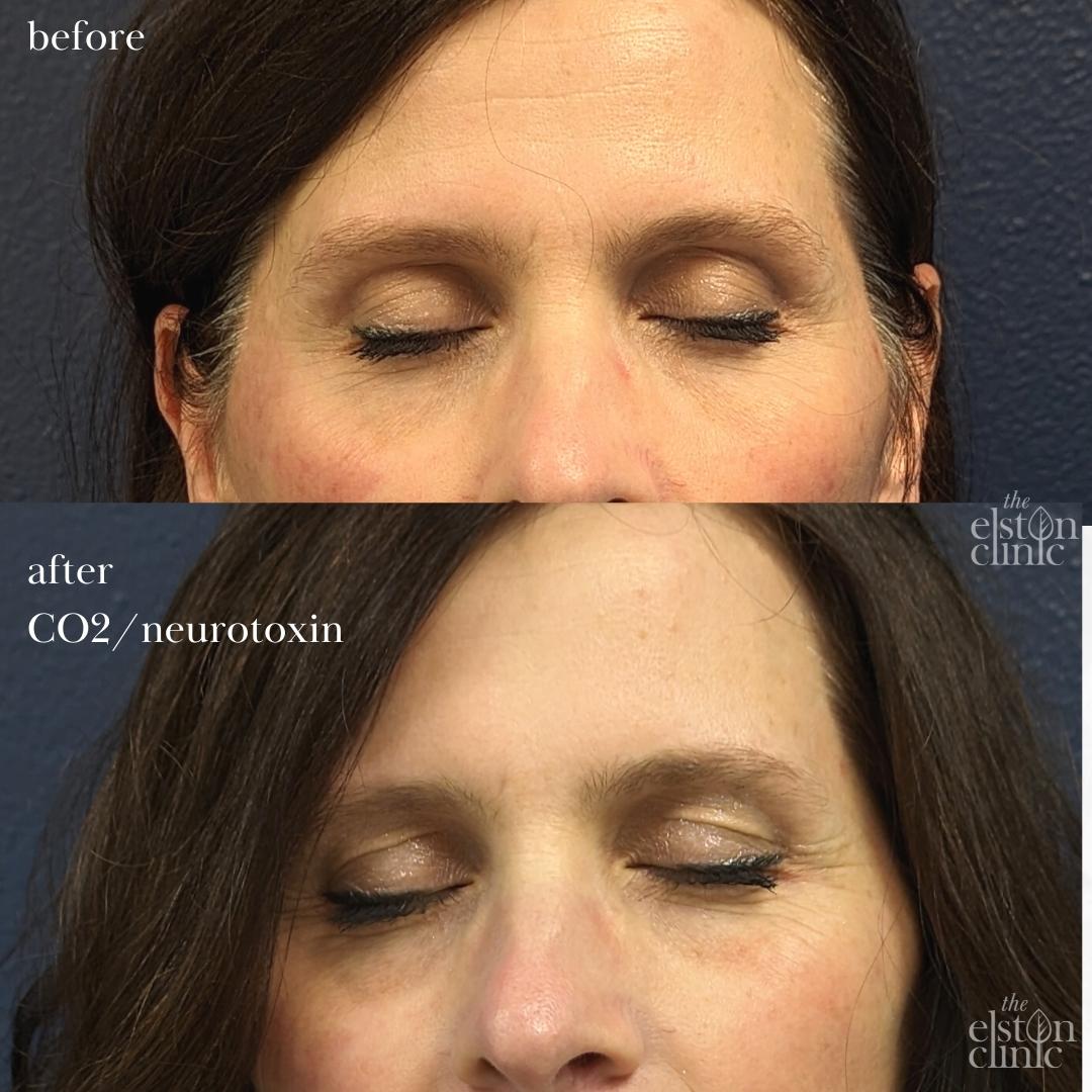 Before and after images of a patient who underwent CO2 laser resurfacing and neurotoxin of the face at the Elston Clinic