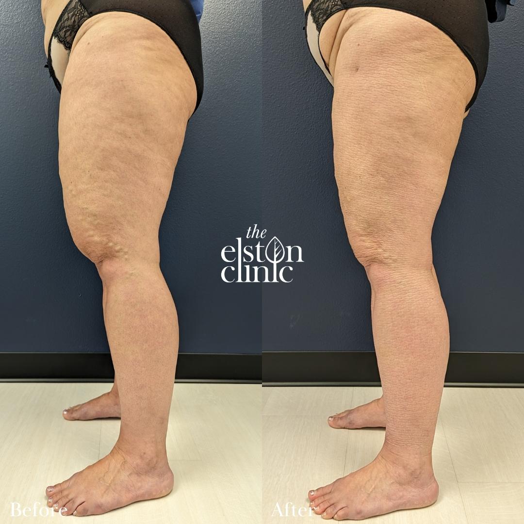 Before and after images of a patient who underwent lipedema liposuction