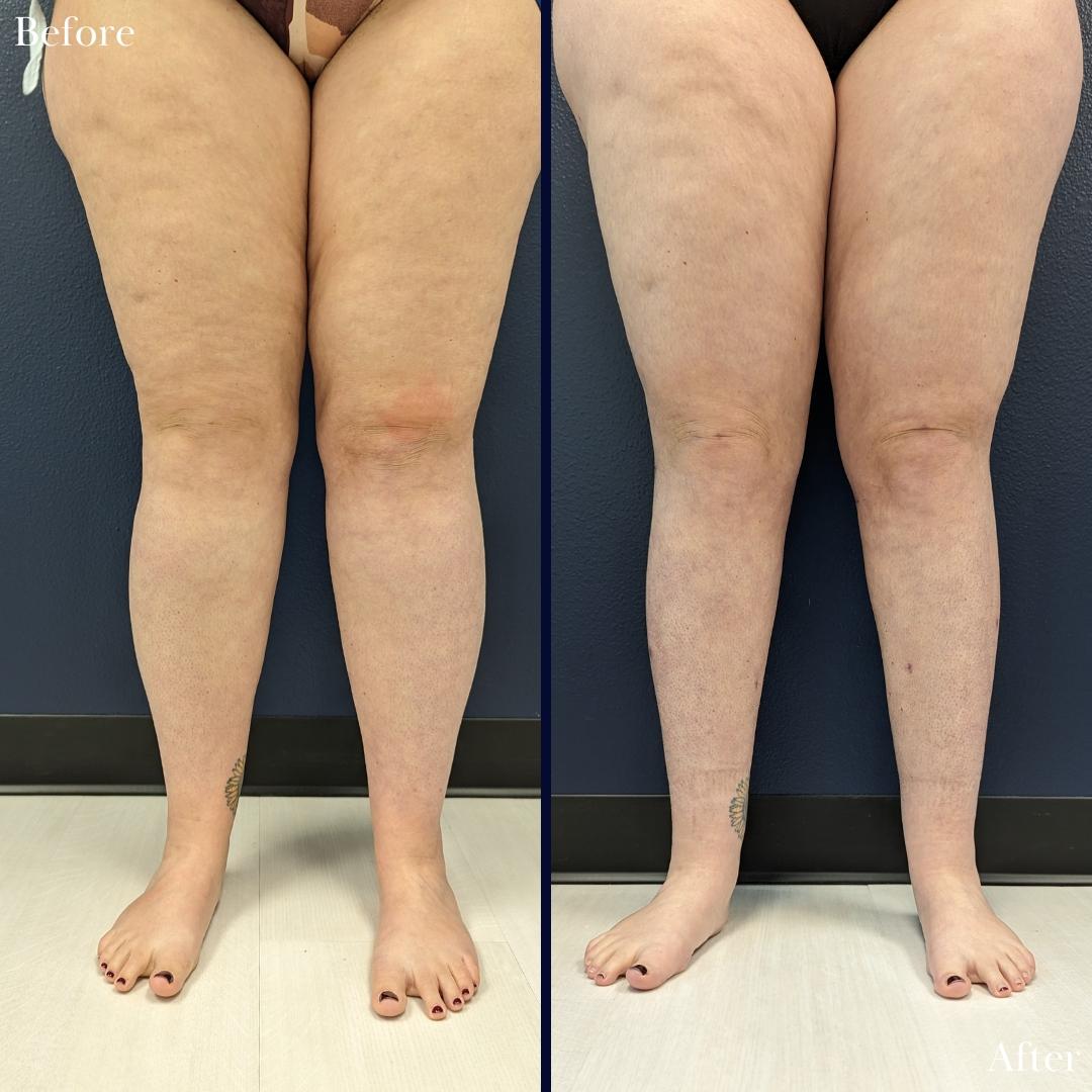 Before and after images of a patient who underwent awake lipedema liposuction