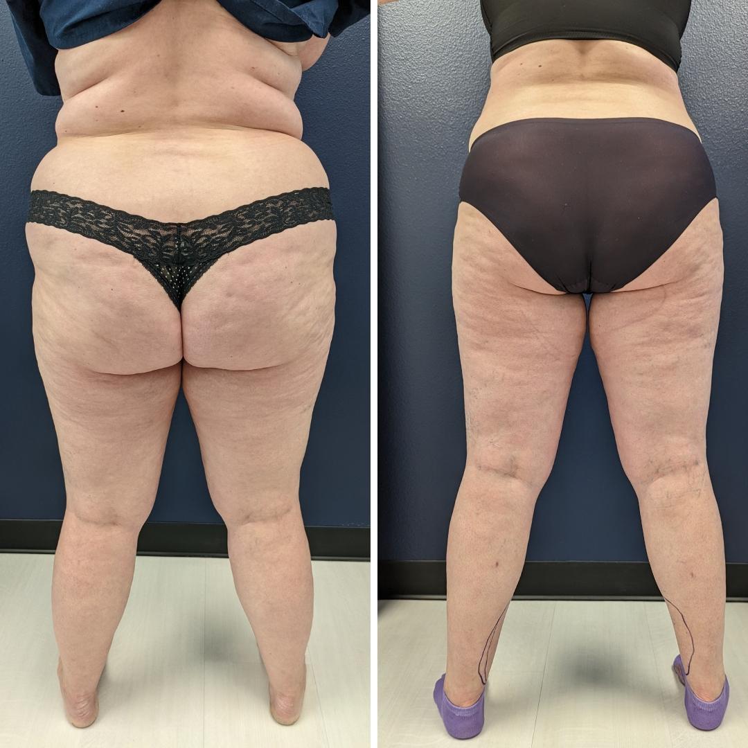 Before and after images of a patient that underwent awake lipedema liposuction