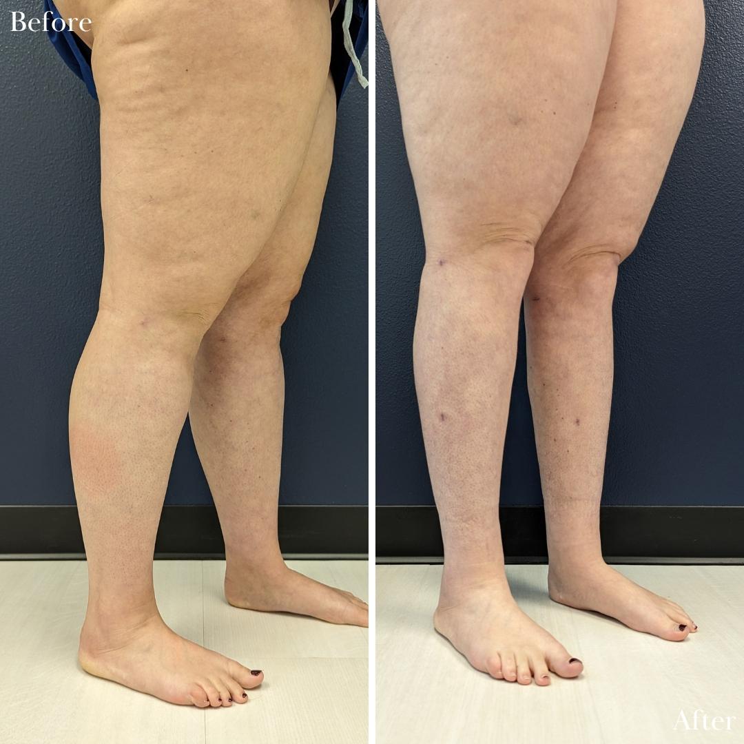 Before and after images of a patient who underwent awake lipedema liposuction