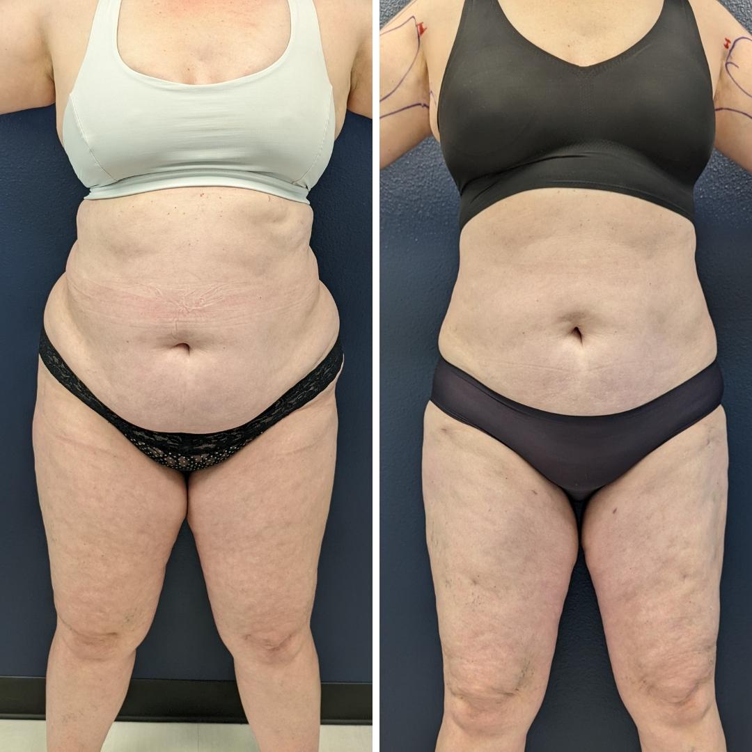 Before and after images of a patient that underwent awake lipedema liposuction